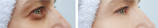 Erase Dark Circles Naturally- Home Remedies for Dark Circles