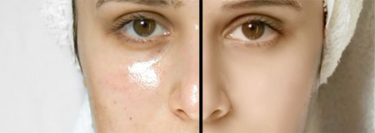 The Science of Oily Skin: Biossential's Magical Cleansing and Toning Routine
